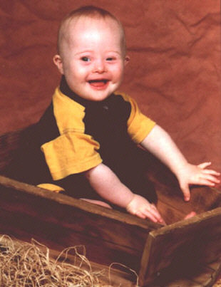 Jacob, a Down Syndrome kid, aged 1 year.