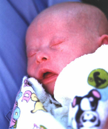 Jacob with Down Syndrome as a new born infant.