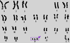 Down syndrome is marked by 3 chromosome 21, instead of just 2