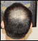 Before hair restorer